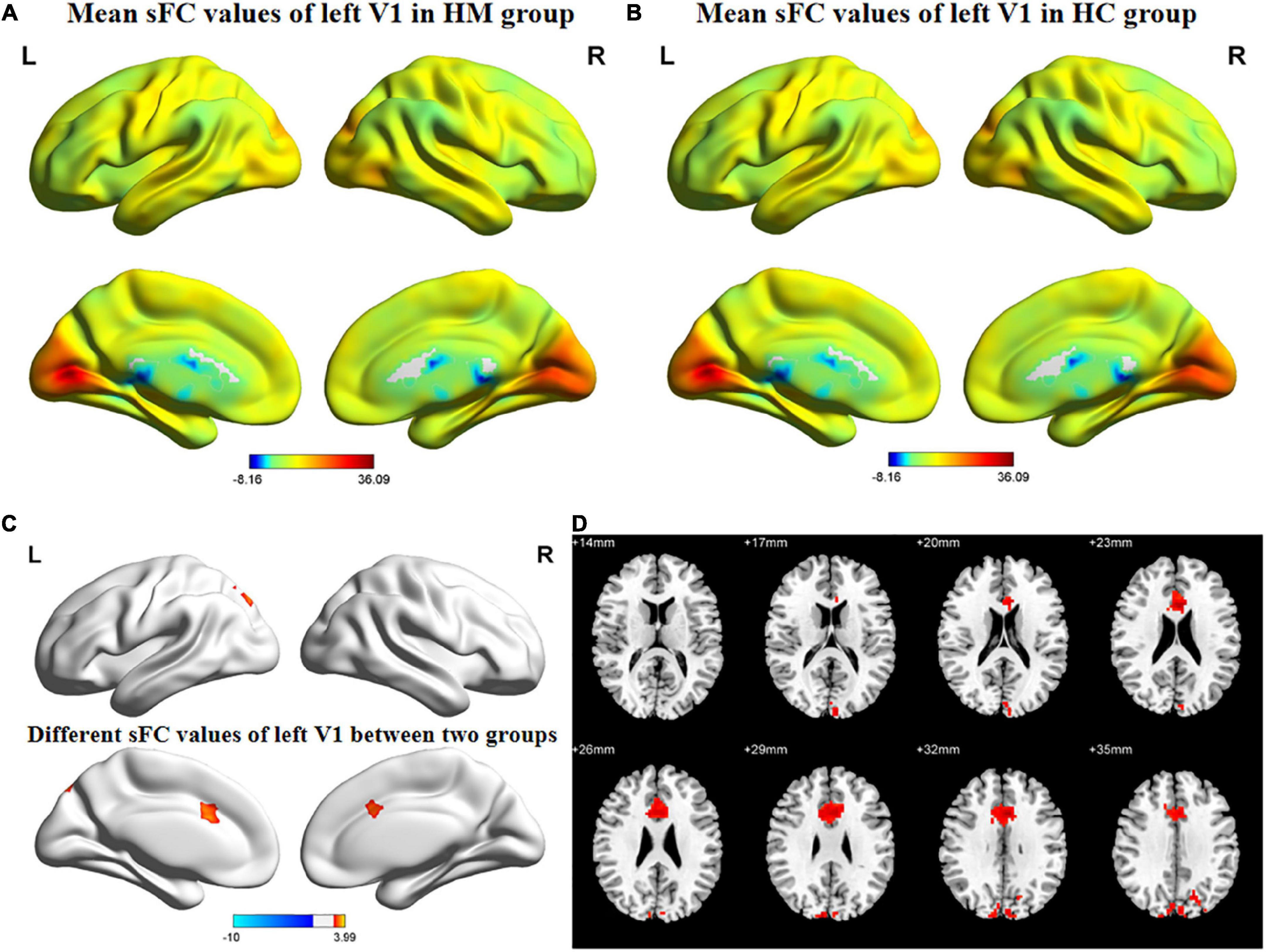 Exploration of static functional connectivity and dynamic functional connectivity alterations in the primary visual cortex among patients with high myopia via seed-based functional connectivity analysis